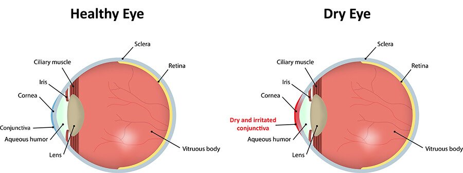 Chart Showing a Healthy Eye Vs One With Dry Eye