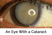 Any Eye With a Cataract