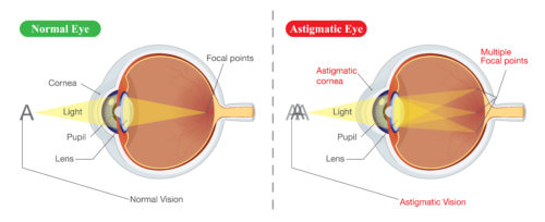 Normal Eye vs. Astigmatic Eye