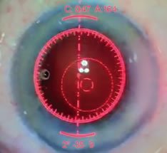 example of limbal relaxing incision with ORA