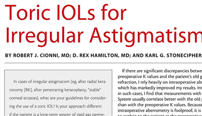 Toric IOLs For Irregular Astigmatism Crst 2014