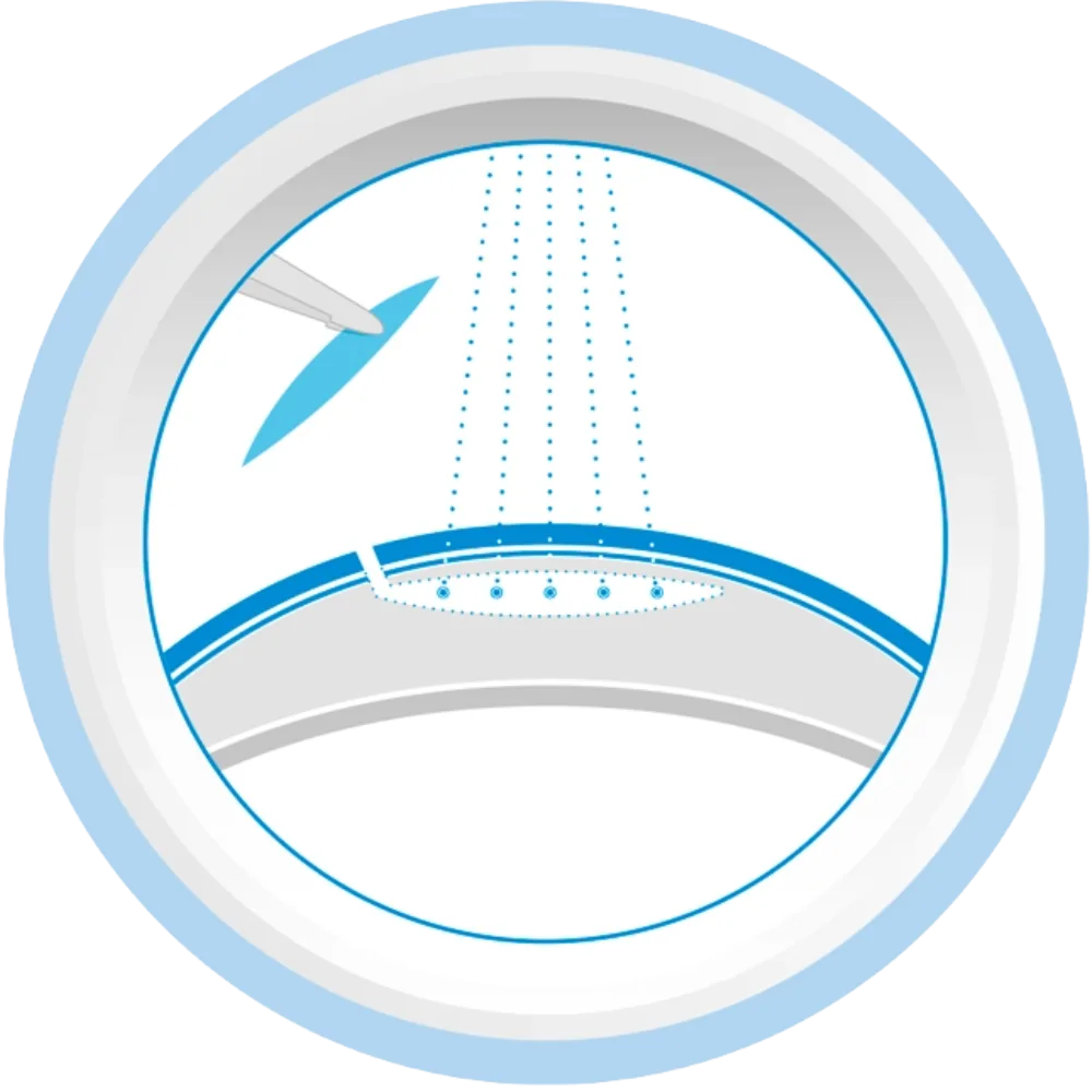 SMILE procedure icon