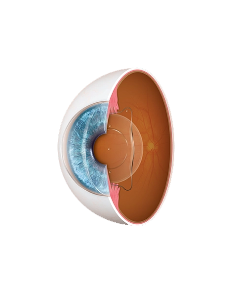 Illustration of EVO ICL