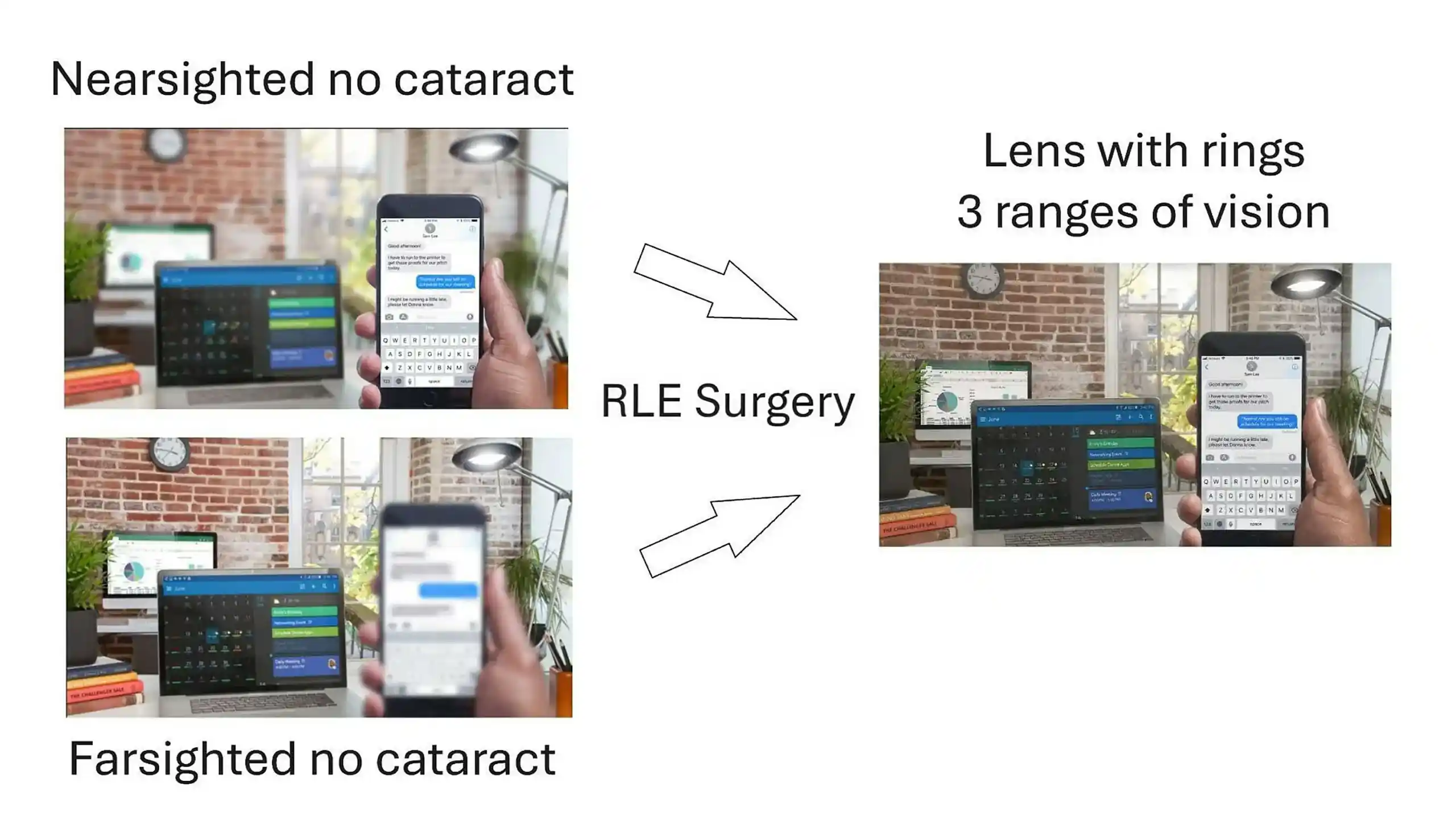 Nearsighted and Farsighted vision with no cataracts before and after RLE Surgerys